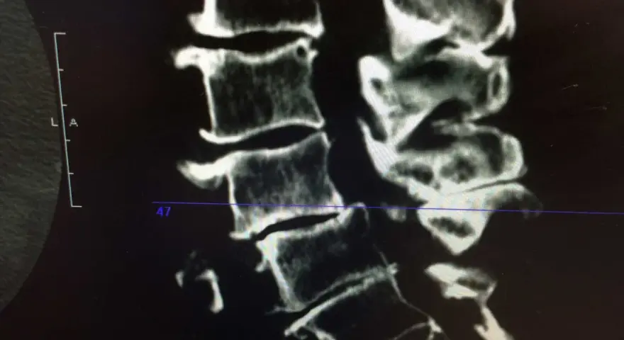 Radiographie montrant l'arthrose cervicale d'un cheval, avec des signes de dégénérescence osseuse au niveau des vertèbres.