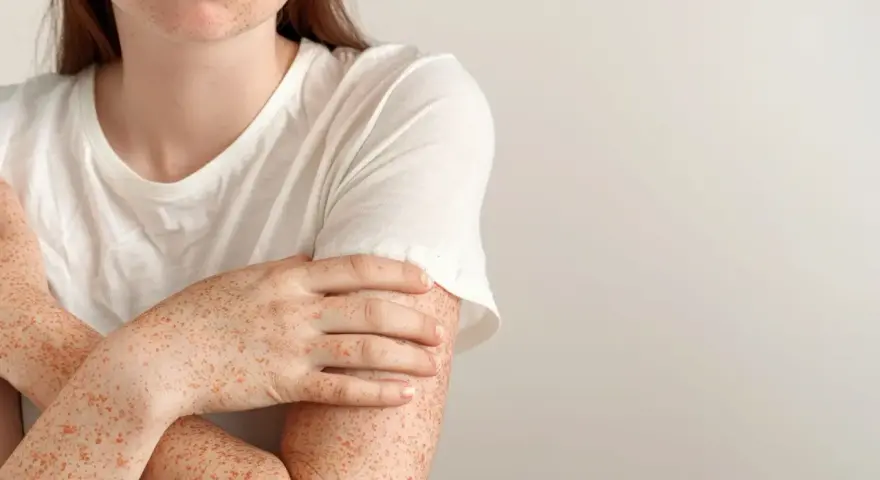 Alergia na nikiel w jamie ustnej 19% dorosłych cierpi. Poznaj objawy i leczenie