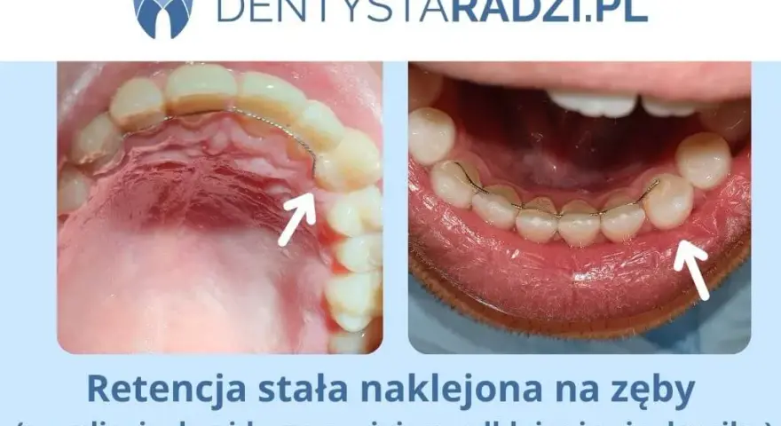Ile kosztuje nakładka retencyjna? Ceny, opcje i porady eksperta