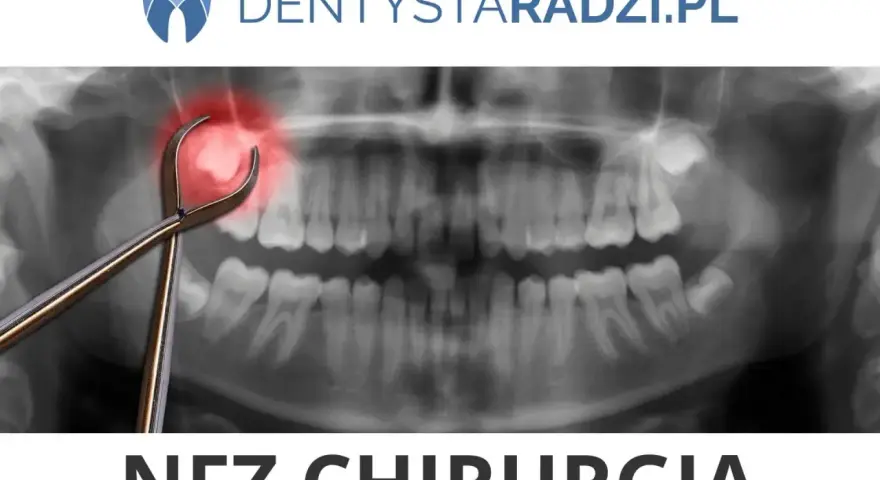 Ile kosztuje usunięcie ósemki na nfz? Sprawdź, co musisz wiedzieć