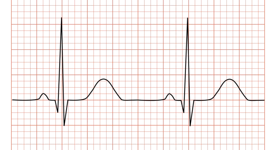 En EKG-kurva visas på ett rutnät. Denna hrv tabell visar hjärtats rytm.