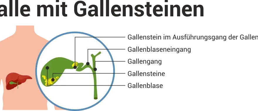 Verstopfte Gallengänge: Symptome erkennen & Ursachen verstehen