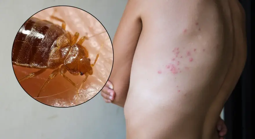 Primer plano de una chinche sobre piel humana, con erupciones rojas visibles en la espalda, indicando picaduras de chinches en el cuerpo.