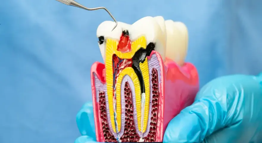 Model zęba z widocznym ubytkiem i narzędziem dentystycznym. Zastanawiasz się nad leczeniem kanałowym? Cena może być niższa niż myślisz.