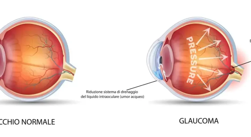 Confronto tra occhio normale e occhio con glaucoma. L'immagine mostra come la pressione elevata nel glaucoma danneggi il nervo ottico.