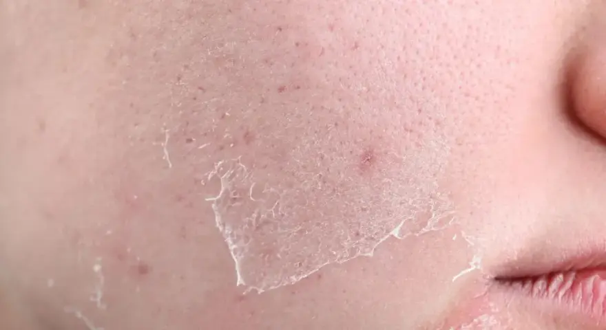 Close-up of dry, flaky skin with peeling patches, indicating what causes transepidermal water loss.