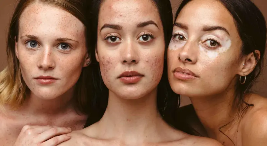 Drei Frauen mit unterschiedlichen Hauttypen: Sommersprossen, Akne und Vitiligo. Jede Haut verdient die passende mischhaut pflege.