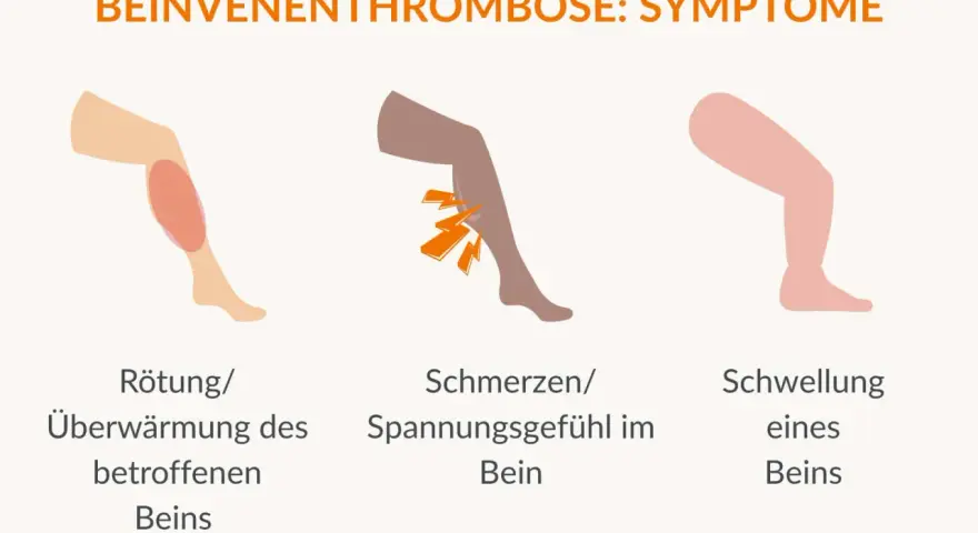 Rötung, Schmerzen und Schwellung am Bein sind Symptome, die auf eine Thrombose hinweisen können. Achte auf diese Anzeichen!