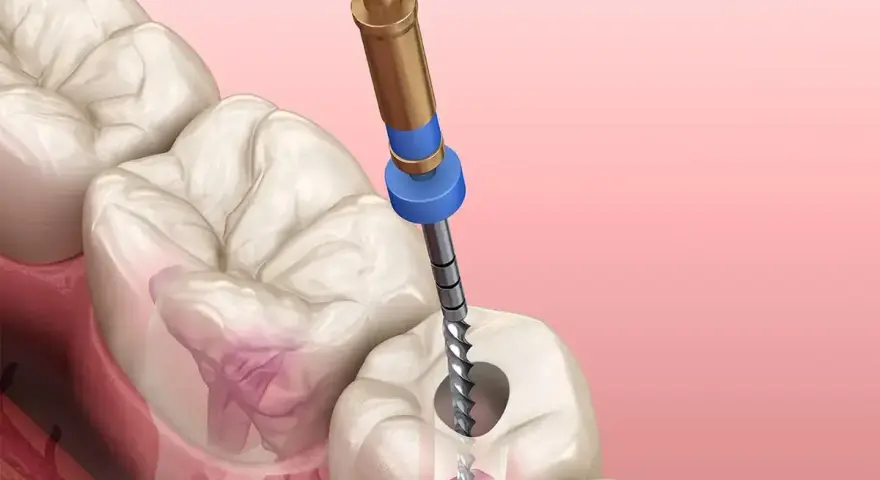 Ząb z ropą wymaga leczenia kanałowego. Dentysta używa narzędzia do oczyszczenia zainfekowanego kanału.