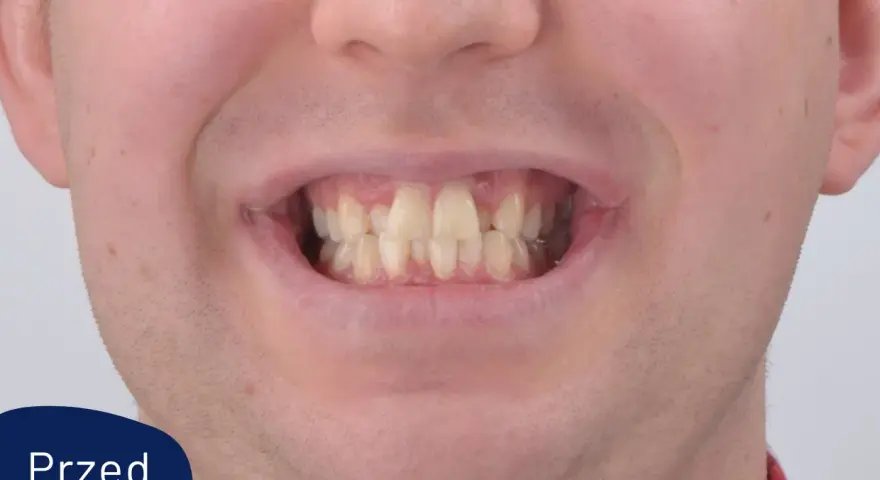 Uśmiech przed leczeniem aparatem Invisalign. Widoczne nierówne i lekko pożółkłe zęby.