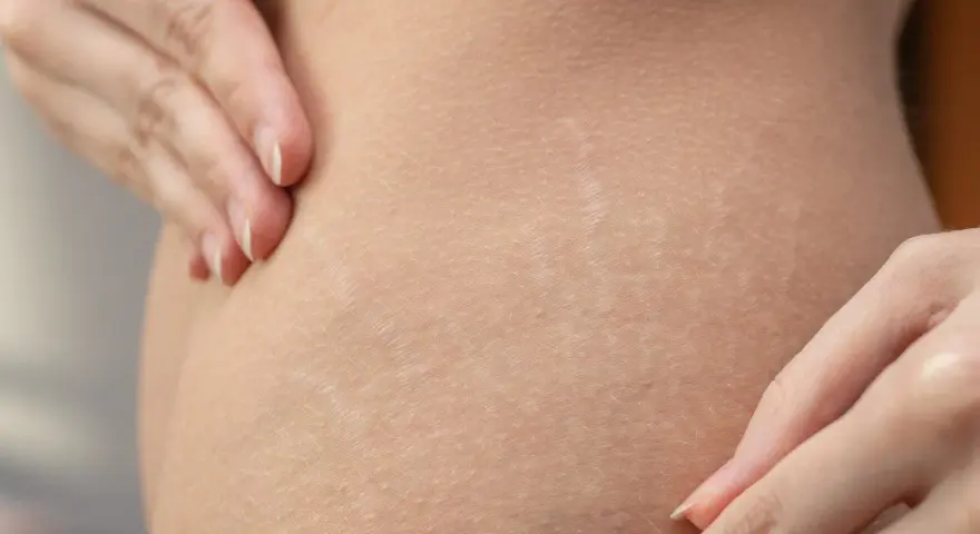 Delikatne rozstępy u nastolatków, widoczne na skórze, są naturalnym etapem dojrzewania. Dłonie delikatnie dotykają skóry.