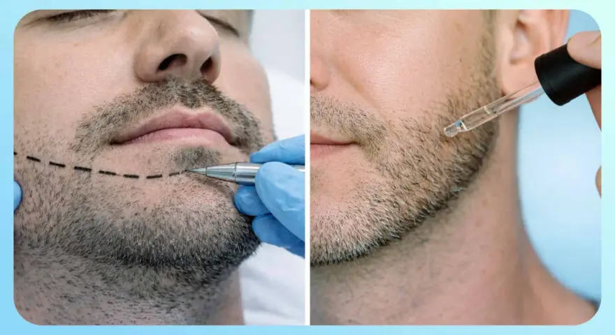 Doble imagen: un hombre con línea marcada en la barba y un aplicador, y otro hombre recibiendo gotas de minoxidil.