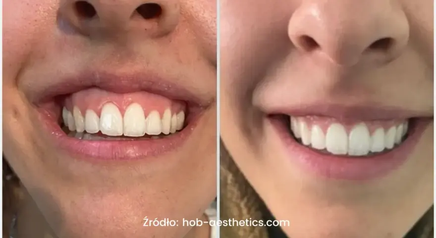 Uśmiech z widocznymi zębami i dziąsłami, porównanie przed i po zabiegu. Zniknął problem gummy smile.