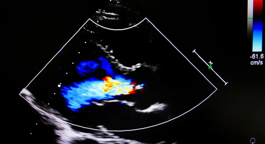 Obraz USG serca z kolorowym Dopplerem, pokazujący przepływ krwi. Może być pomocny w diagnostyce przewlekłej niewydolności żylnej.