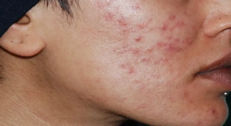 Primo piano del viso di una persona con evidenti cicatrici da acne sul lato destro della guancia e sul mento.