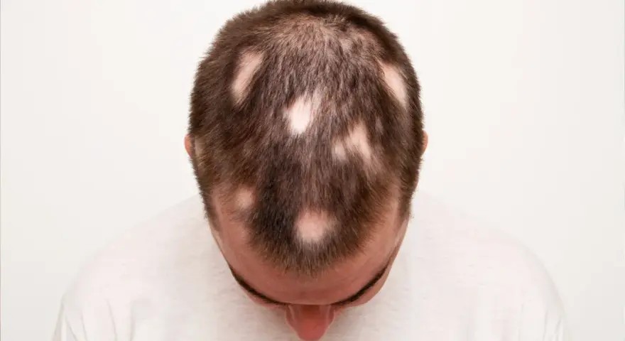 Calvizie a chiazze sulla testa di un uomo, sintomo di alopecia da stress.