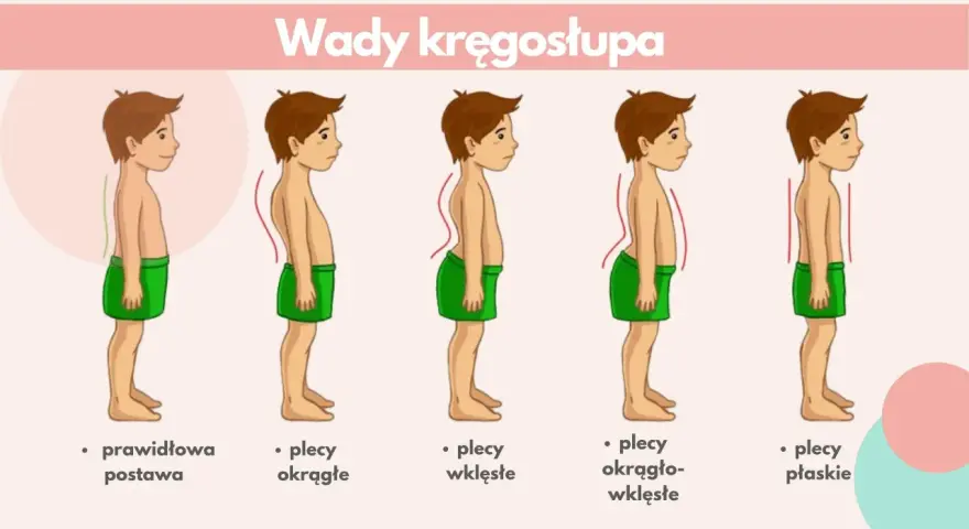 Ilustracja pokazuje wady kręgosłupa: plecy okrągłe, wklęsłe, okrągło-wklęsłe i płaskie, obok prawidłowej postawy.