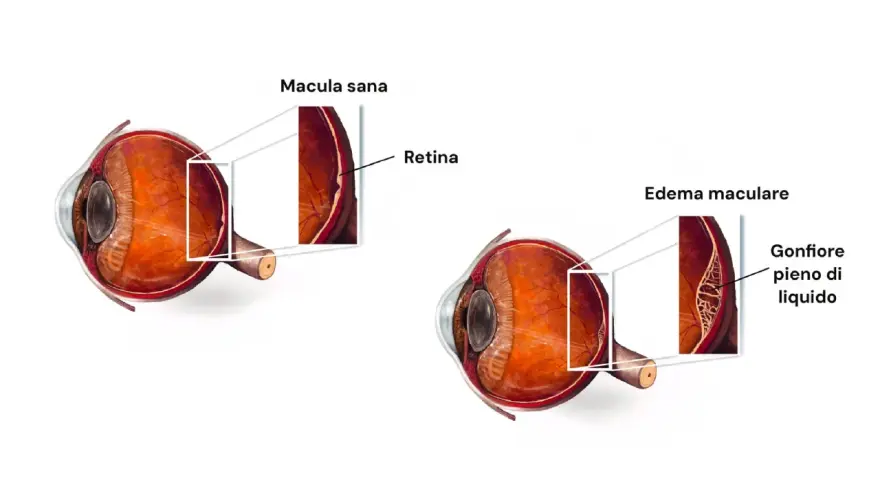Confronto tra occhio sano e occhio con edema maculare. L'edema maculare si riassorbe, mostrando la retina gonfia e piena di liquido.