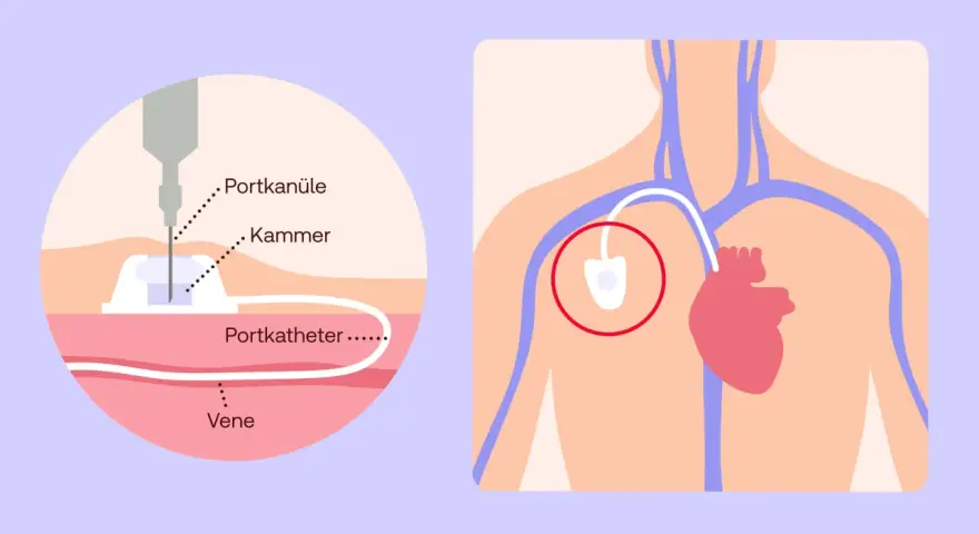 Illustration zeigt eine Portkanüle, die in eine Vene eingeführt wird, um Chemotherapie zu verabreichen.