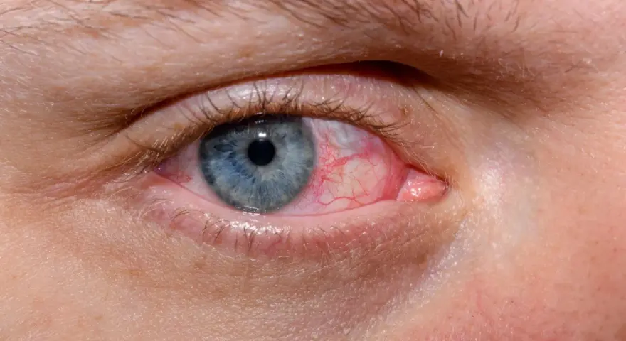 Occhio azzurro con congiuntiva arrossata e vasi sanguigni evidenti. Esistono gli occhi rossi, un segno di irritazione o infezione.