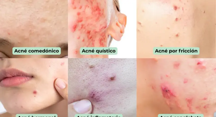 Seis tipos de acné: comedónico, quístico, por fricción, hormonal, inflamatorio y   conglobata.