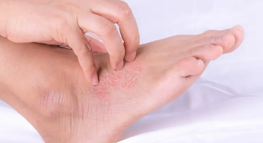 Una mano se rasca la piel escamosa y enrojecida de un pie, mostrando los efectos de la psoriasis en los pies.