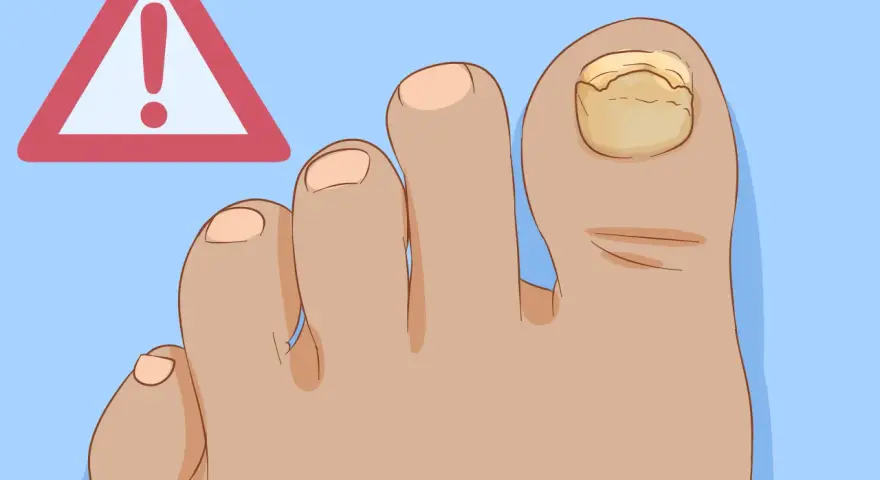 Alluce senza unghia cosa fare? Attenzione! L'unghia dell'alluce è ingiallita e ispessita, segno di possibile micosi.