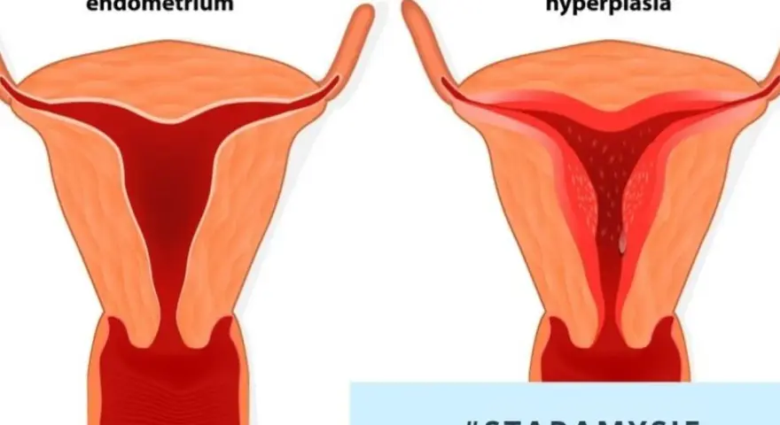 Porównanie prawidłowego endometrium z przerostem. W przypadku przerostu endometrium, zabieg jest kluczowy dla zdrowia.