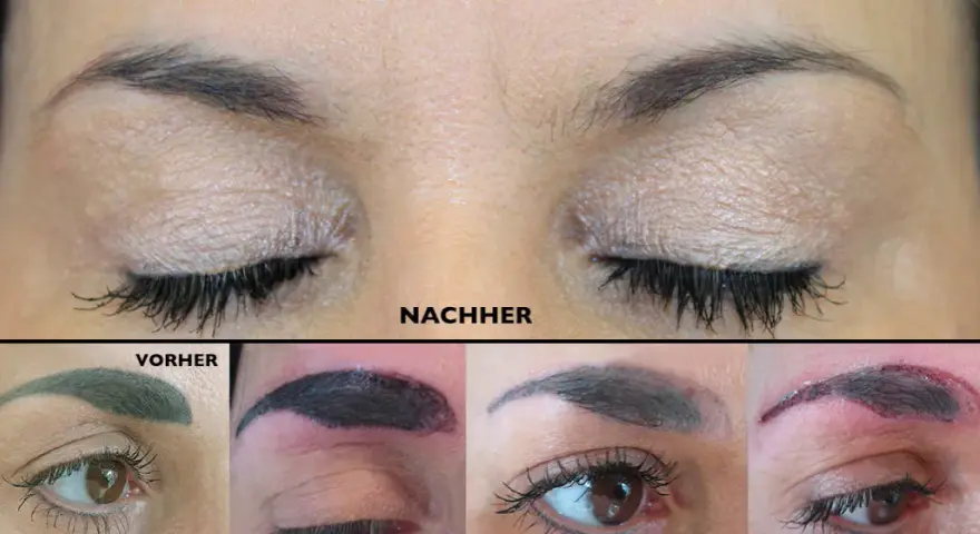 PMU entfernen: Was Sie über Laser, Remover & Kosten wissen müssen