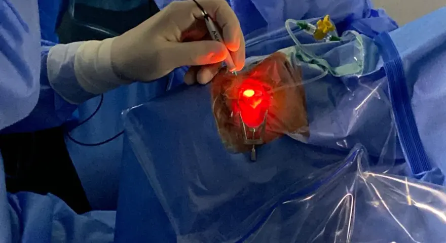 Un chirurgo esegue una vitrectomia, un intervento per rimuovere il corpo vitreo dall'occhio.
