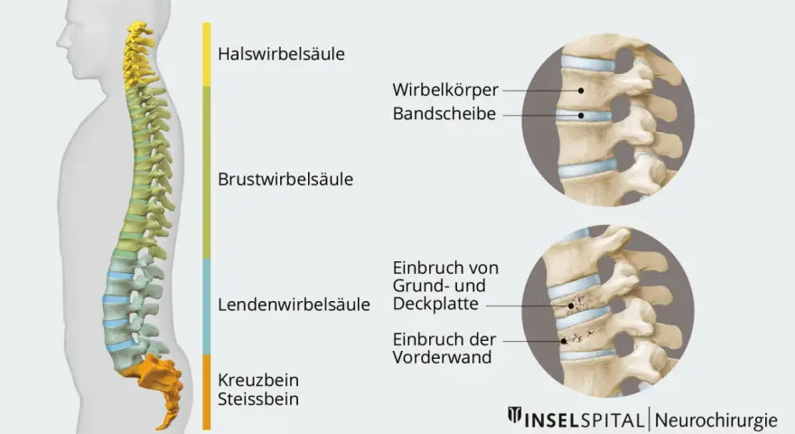 Illustration der Wirbelsäule mit Darstellung eines Wirbelbruchs. Mögliche wirbelbruch symptome werden durch die gezeigten Frakturen verdeutlicht.