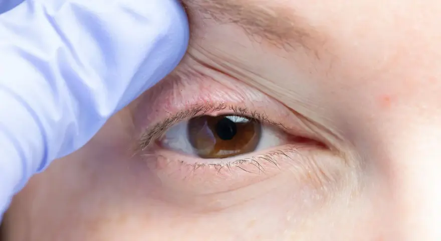 Occhio con palpebra sollevata da guanto blu, evidenziando arrossamento e possibili ghiandole di meibomio ostruite, cause di disagio.