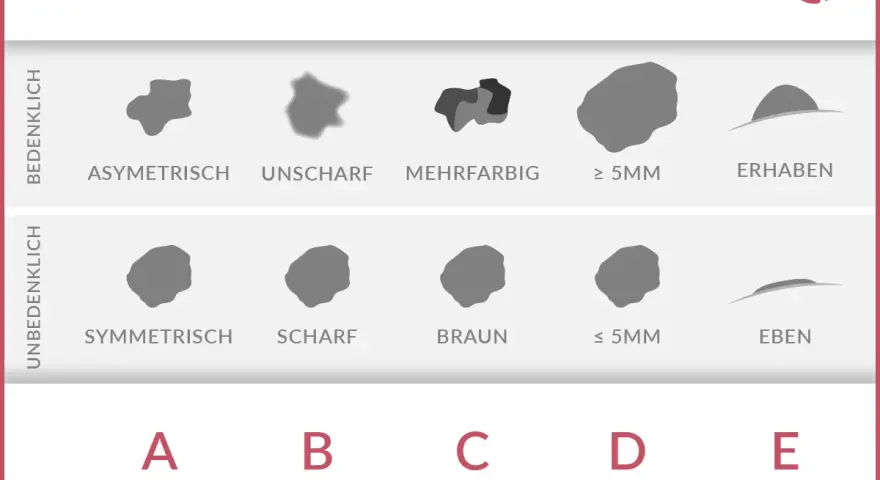 ABCDE-Regel zur Früherkennung von Hautkrebs: Asymmetrie, Begrenzung, Colorit, Durchmesser, Erhabenheit. Hilft, Hautkrebs frühzeitig zu erkennen.