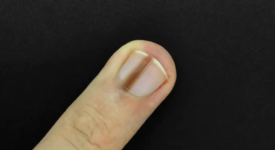 Un ongle de doigt présente une ligne verticale brune, un signe possible de carence en fer.