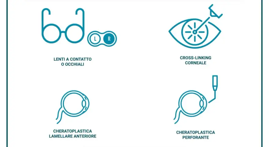 Illustrazione delle cure per il cheratocono: lenti, cross-linking, cheratoplastica lamellare e perforante. Queste opzioni aiutano a gestire le conseguenze del cheratocono.