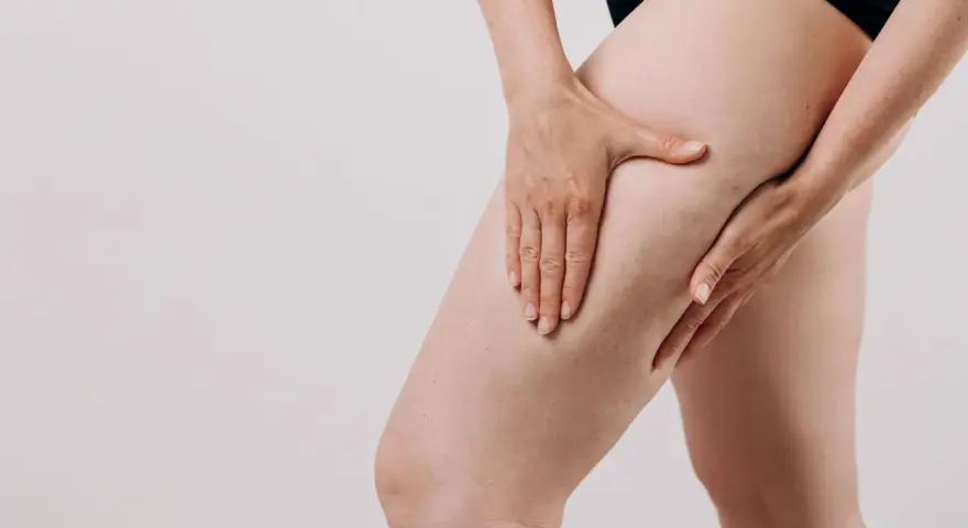 Une femme touche sa cuisse, montrant les capitons de la cellulite.