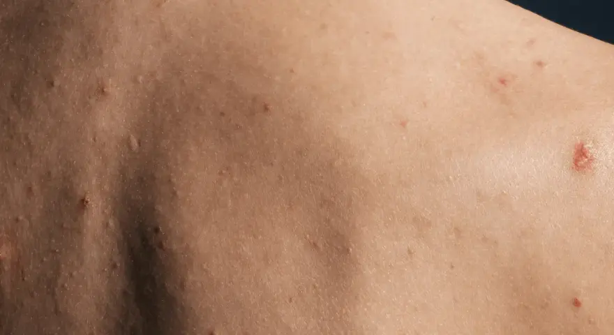 Co na pryszcze na plecach? Od domowych metod po dermatologa