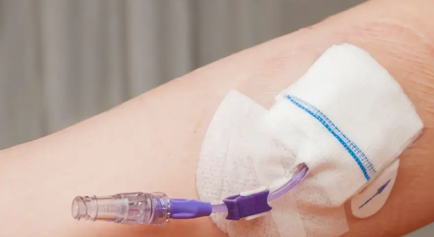 Cewnik do żywienia pozajelitowego podłączony do ręki. Zapewnia niezbędne składniki odżywcze, gdy tradycyjne żywienie jest niemożliwe.