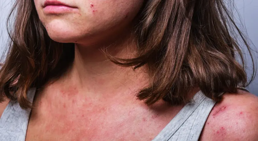 Hilfe bei trockener, roter, schuppiger Gesichtshaut: Mein Experten-Plan