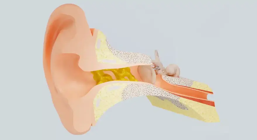 Sezione anatomica dell'orecchio con cerume giallo che blocca il condotto uditivo, impedendo all'acqua nelle orecchie di uscire.