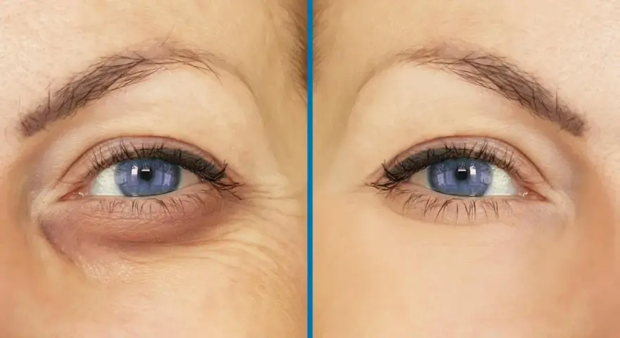 Antes y después de un tratamiento para ojeras y arrugas. Los ojos hundidos se ven más luminosos y la piel más tersa.