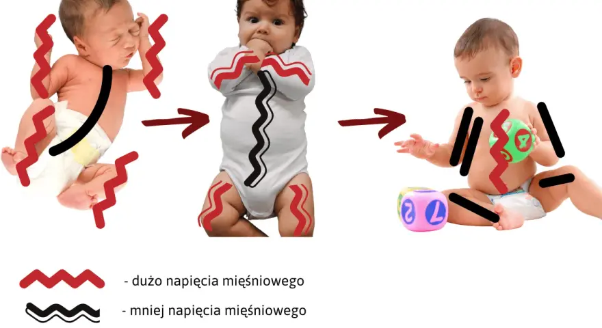 Dziecko sie napina, od noworodka z dużym napięciem, przez niemowlę z mniejszym, do starszego dziecka z minimalnym napięciem.