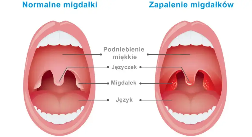 Porównanie budowy gardła: zdrowe migdałki po lewej, zapalone po prawej.