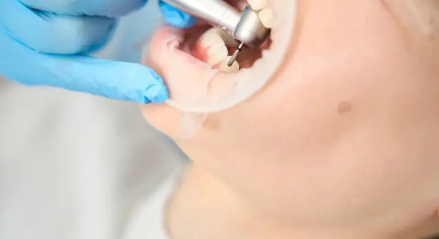 Co dentysta wkłada w zębodół po ekstrakcji? Wszystko, co musisz wiedzieć