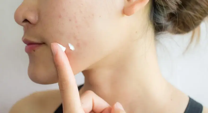 Pasta do zębów na pryszcze? Dermatolodzy: To mit i szkoda dla skóry