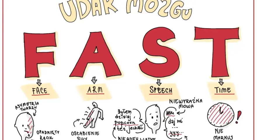 FAST - objawy udaru mózgu: opadnięta twarz, osłabienie ręki, problemy z mową, czas. Odmiana przypadków jest kluczowa.