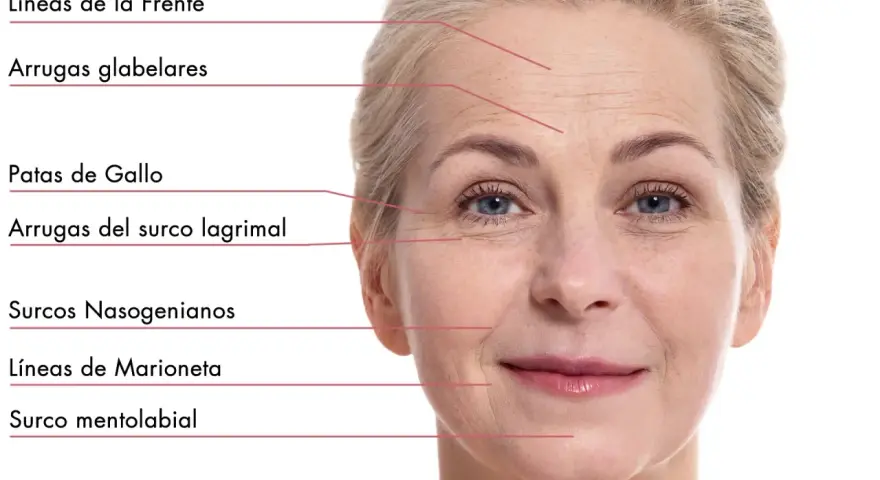 Rostro de mujer con líneas de expresión marcadas, mostrando arrugas estáticas en frente, ojos y alrededor de la boca.