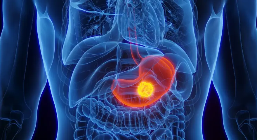 Anatomische Darstellung des menschlichen Oberkörpers mit hervorgehobenem Magen. Ein leuchtend gelber Tumor im Magen könnte ein Anzeichen für Magenkrebs sein.