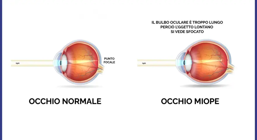Confronto tra occhio normale e occhio miope. La miopia d'indice è causata da un bulbo oculare troppo lungo, che sfoca gli oggetti lontani.