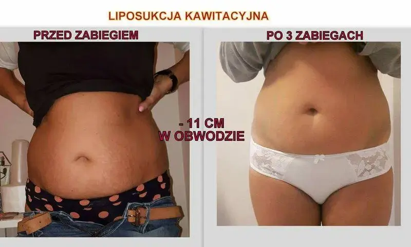 Co lepsze: lipolaser czy liposukcja kawitacyjna? Porównanie skuteczności